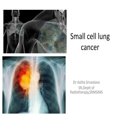 Small cell lung cancer