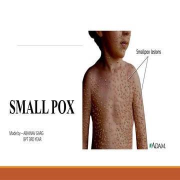Smallpox slideshow | PPTX