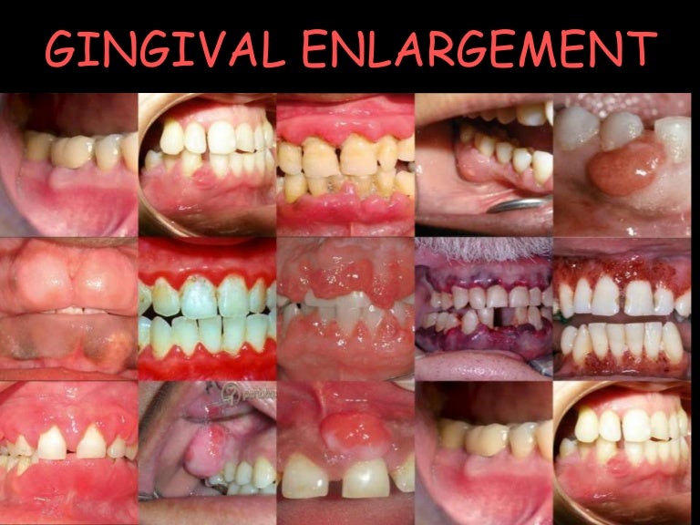 Gingival enlargement
