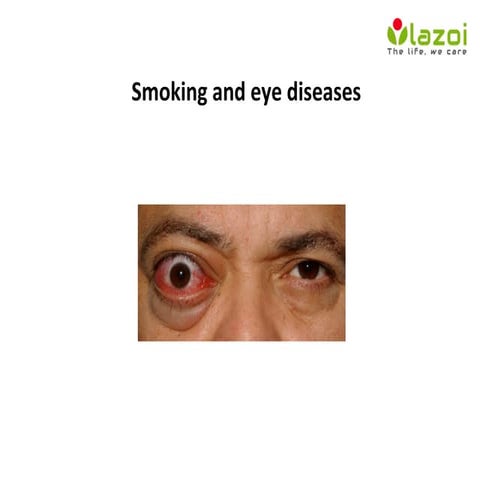 does smoking cigarettes cause eye problems Smoking and eye diseases