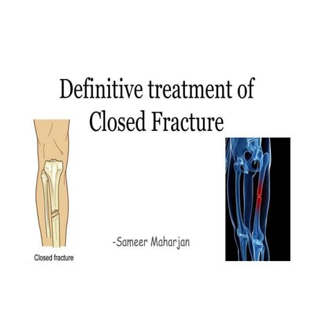 GENERAL PRINCIPLES OF CLOSED AND OPEN FRACTURES | PPT