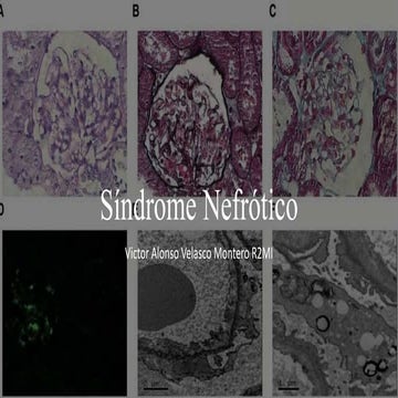 Síndrome Nefrótico.pptx