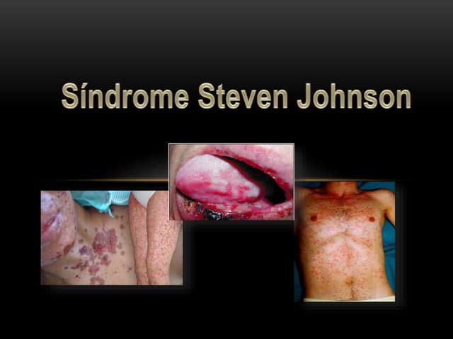 Síndrome de Stevens - Johnson y Necrólisis epidérmica tóxica. | PPTX