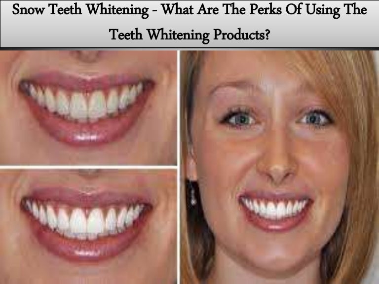 Snow Teeth Whitening - What Are The Perks Of Using The Teeth Whitenin…