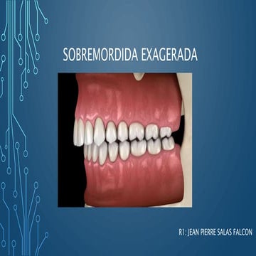 SOBREMORDIDA EXAGERADA SALAS | PPTX
