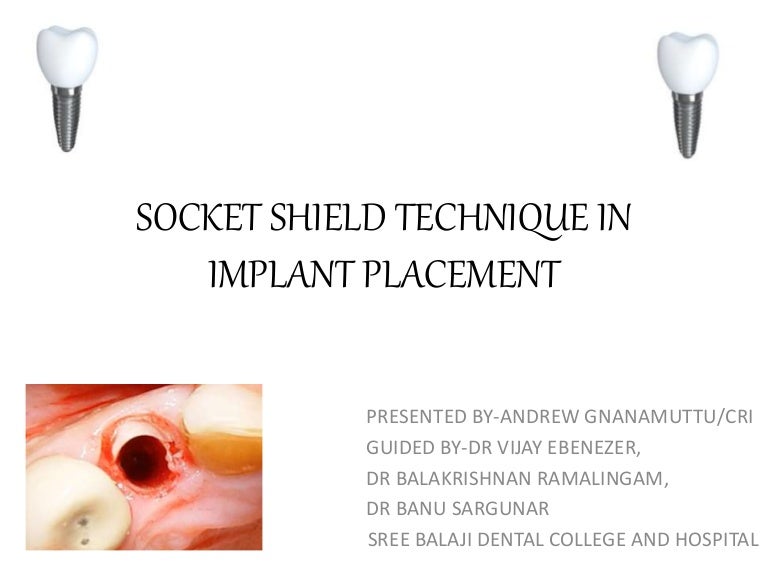 Socket shield technique