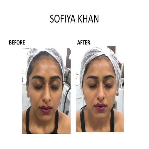 Before After Results by Skinworks