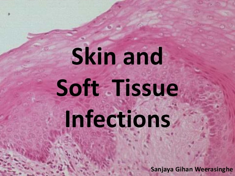 Skin and Soft tissue infections