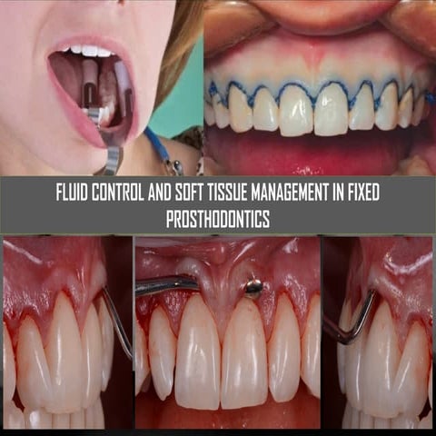 fluid control and soft tissue management in fixed prosthodontics | PPTX