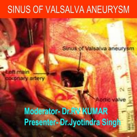 SINUS OF VALSALVA ANEURYSM