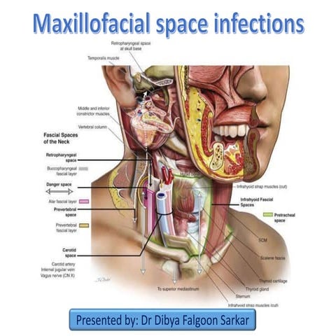 Maxillofacial space infections