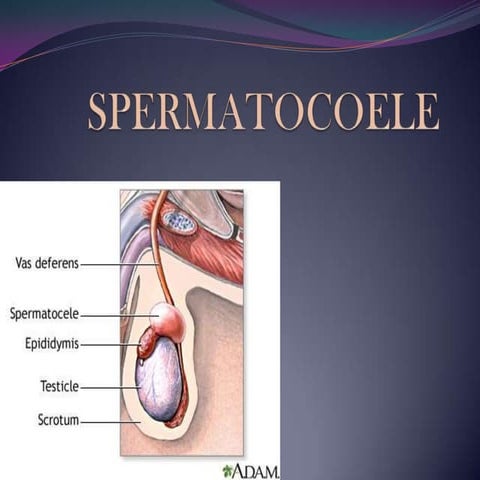 Spermatocoele