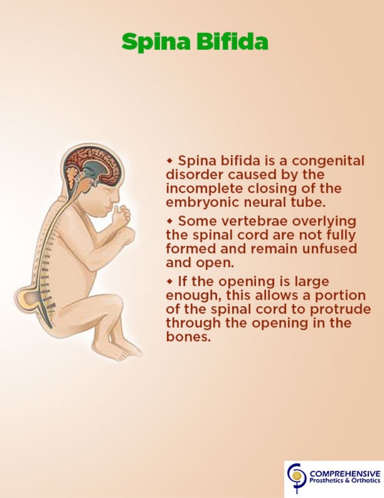 Spina Bifida