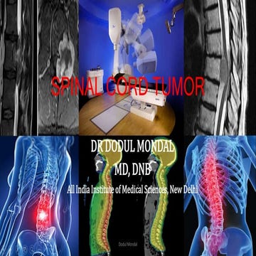 Spinal cord tumor