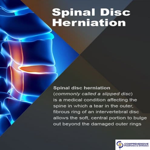 Spinal disc Herniation