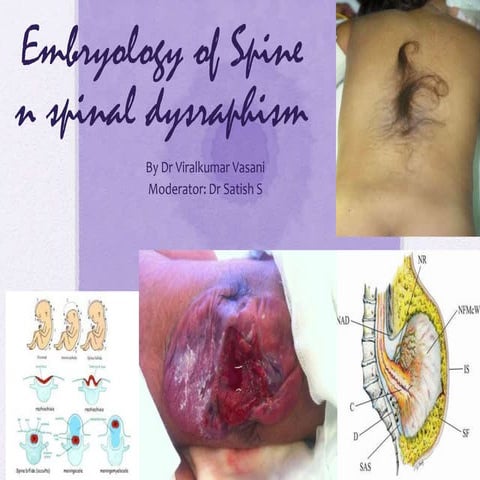 Spinal dysraphism