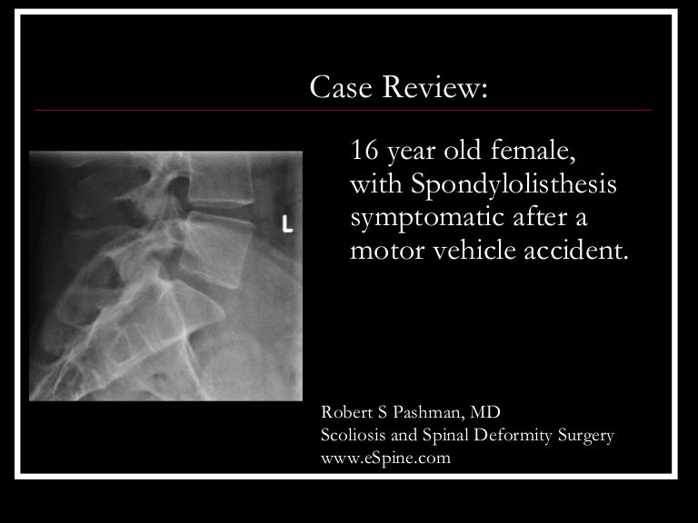 Surgery for spondylolisthesis l5-s1 picture