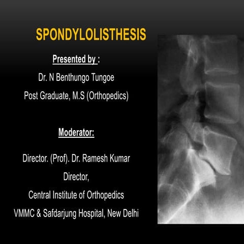 SPONDYLOLISTHESIS: DIAGNOSIS, CLASSIFICATION, EVALUATION AND MANAGEMENT