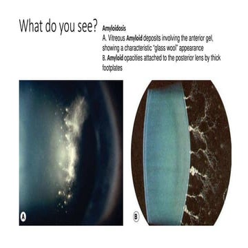 Spot Diagnosis - Look at the pictures-What do you See - Vitreous ...