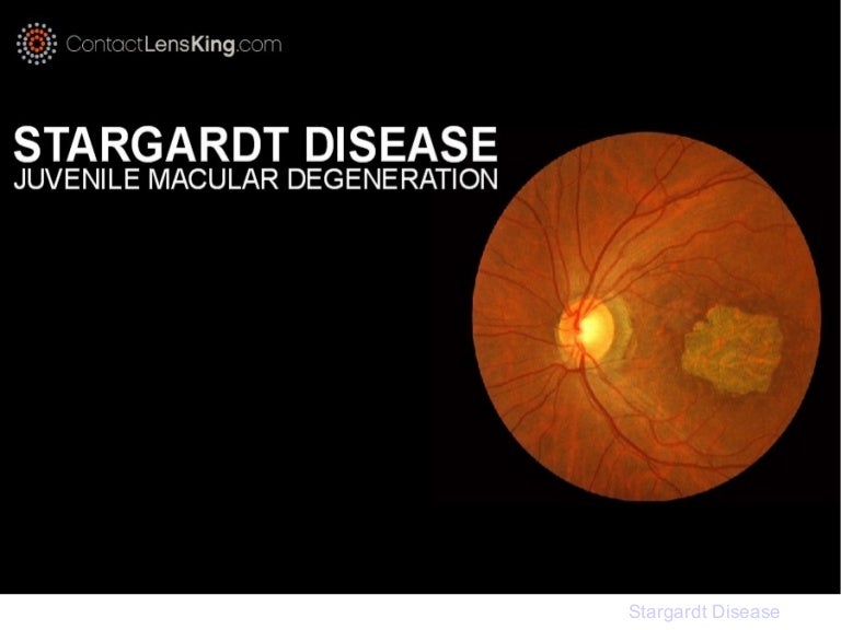 Stargardt Disease Juvenile Macular Degeneration