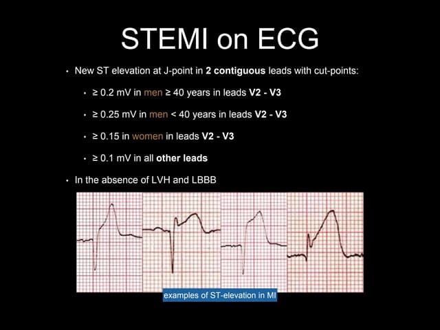 Stemi Criteria PPT stemi-criteria-ppt