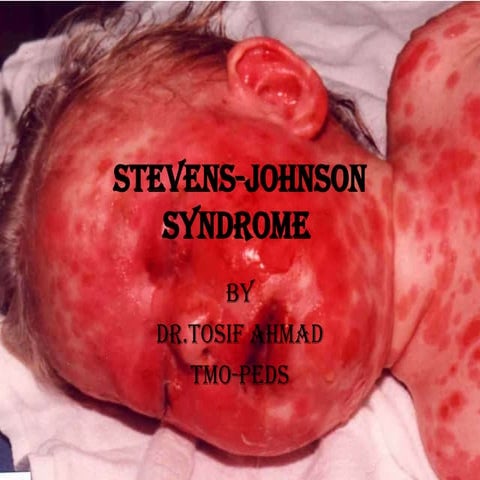 Stevens johnson syndrome