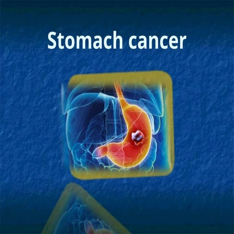 stomach cancer — копия.ppt stomach cancer