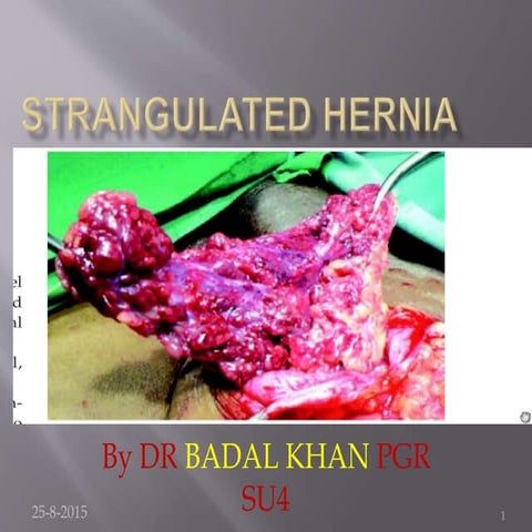 Strangulated hernia