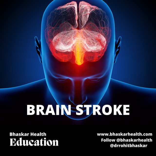 Stroke: Physiotherapy Treatment