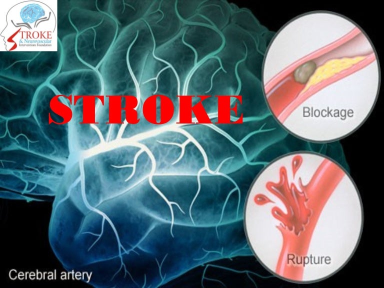StrokeUnderstanding the Basics