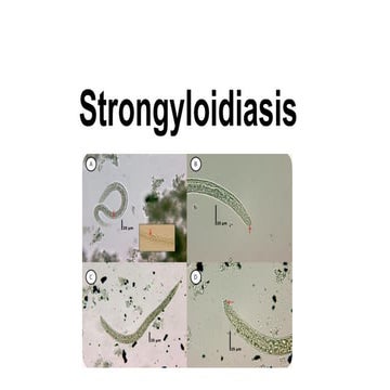 Strongyloidiasis. Infectious disease pptx | PPTX