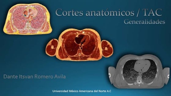 Laminas de la anatomia del corazón- Netter | PDF