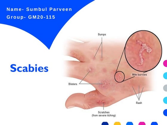 Scabies | PPT