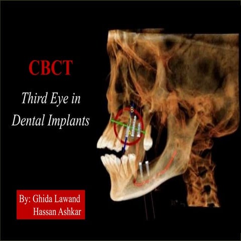 CBCT in Implants- Summary