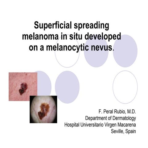 melanotic in situ Labial macule. B). Increased numbers of me-lanocytes along Lentigo maligna - Wikipedia
