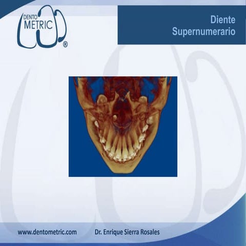 Fractura alveolar y avulsion dentaria, | PPTX