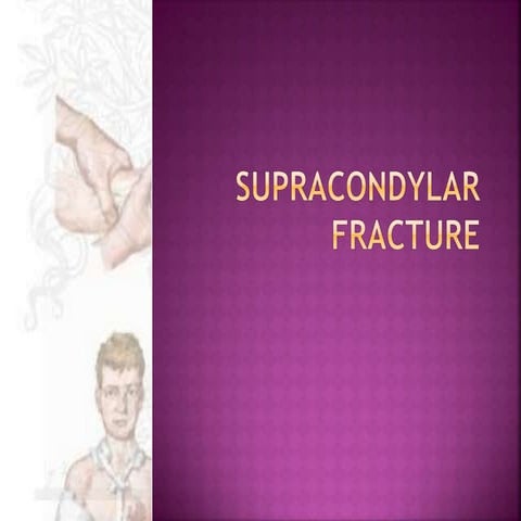 Supracondylar fractures in children
