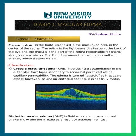 DIABETIC  MACULAR EDEMA