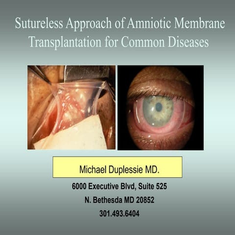 Sutureless amniotic membrane transplantation for common disease