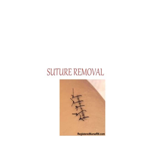 suture removal ppt.pptx medical surgical
