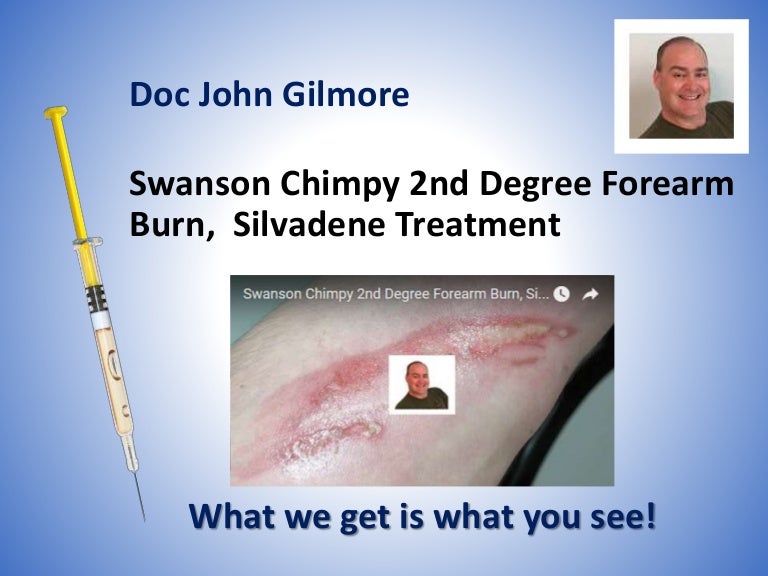 Swanson Chimpy 2nd Degree Forearm Burn, Silvadene Treatment