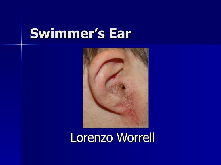 Swimmer’s ear