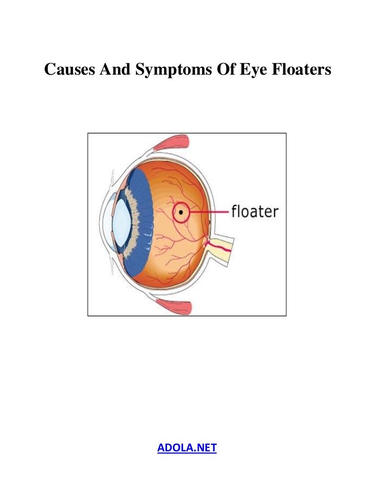 Symptoms and causes of eye floaters