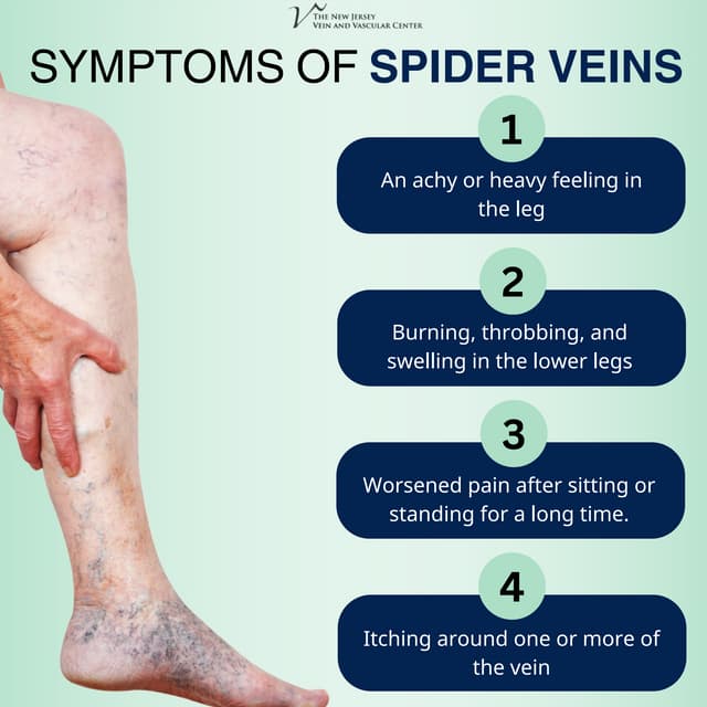 Symptoms of Spider Veins on Ankles.pdf