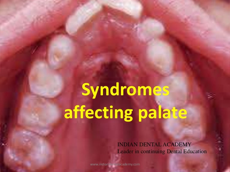 Syndromes affecting the palate/ dental implant courses