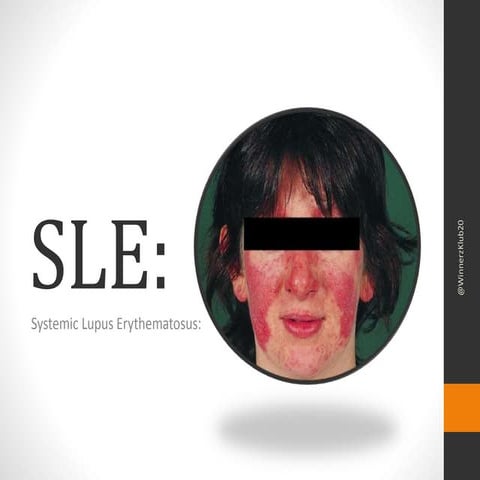 Systemic lupus erythematosus