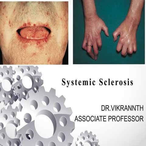 scleroderma disease - connective tissues | PPTX