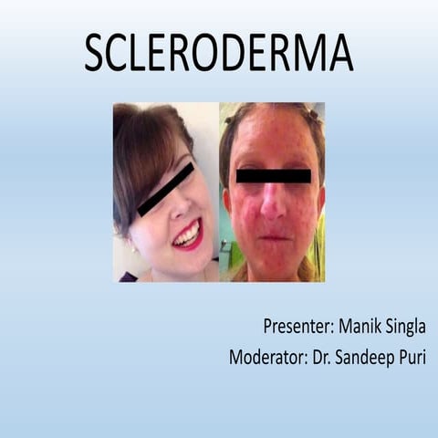 Systemic Sclerosis 2017