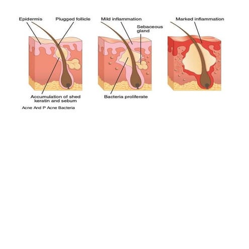 What Causes Acne-How Acne Develops And How To Treat Acne | DOCX