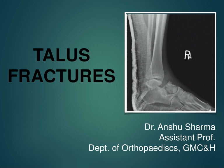 TALUS FRACTURE AND MANAGEMENT.